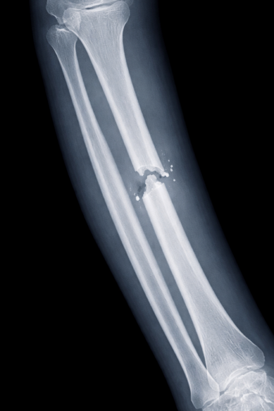 Fracture Treatment in Kathmandu