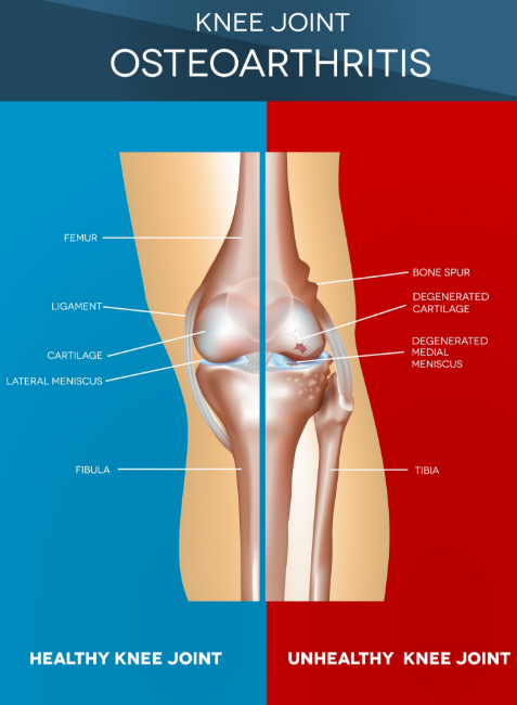 Arthritis treatment in nepal at Nepal National Hospital